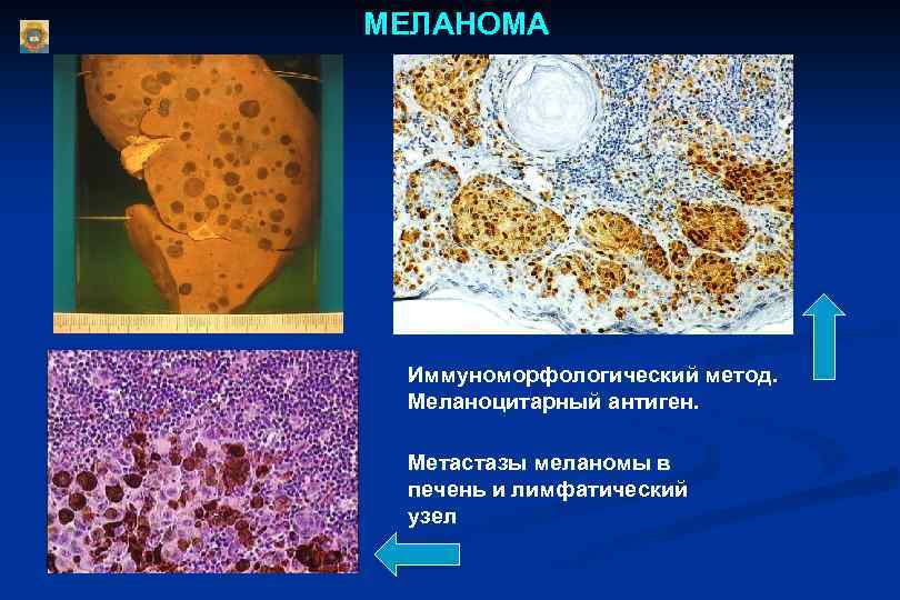 МЕЛАНОМА Иммуноморфологический метод. Меланоцитарный антиген. Метастазы меланомы в печень и лимфатический узел 