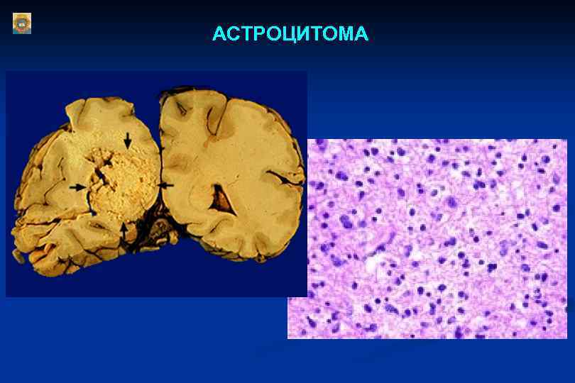 АСТРОЦИТОМА 