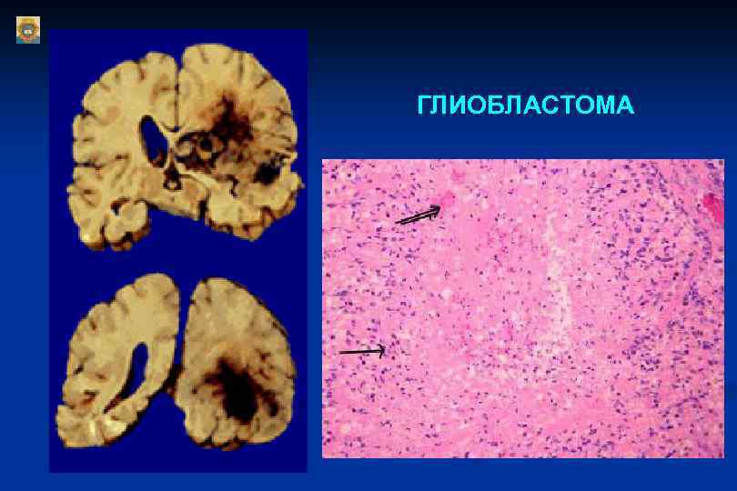 ГЛИОБЛАСТОМА 