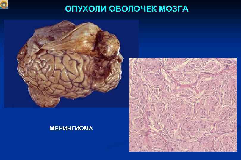 ОПУХОЛИ ОБОЛОЧЕК МОЗГА МЕНИНГИОМА 