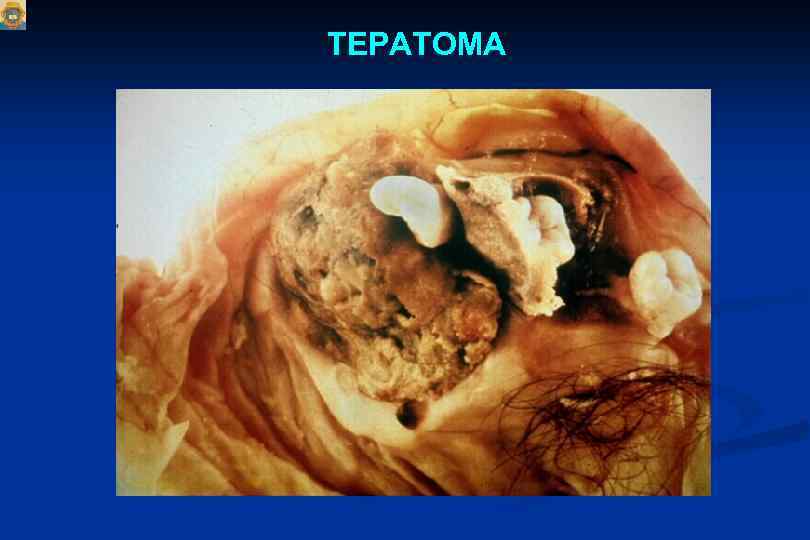 ТЕРАТОМА 