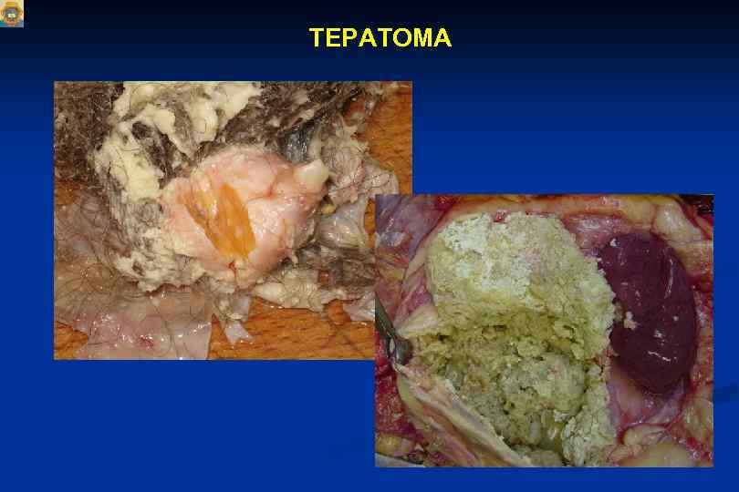 ТЕРАТОМА 