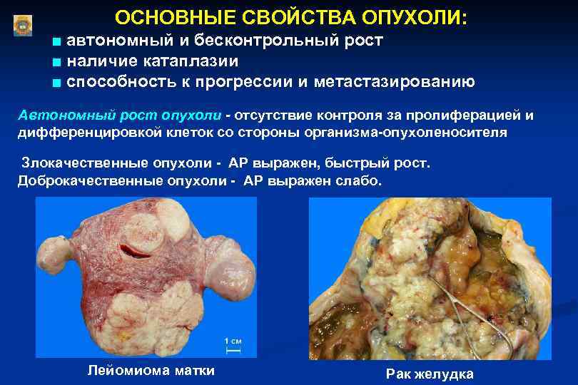 ОСНОВНЫЕ СВОЙСТВА ОПУХОЛИ: ■ автономный и бесконтрольный рост ■ наличие катаплазии ■ способность к