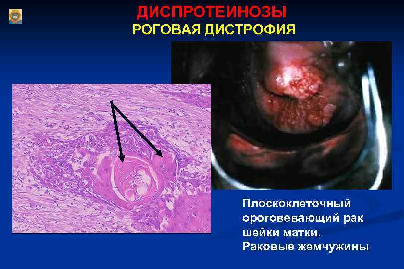 ДИСПРОТЕИНОЗЫ РОГОВАЯ ДИСТРОФИЯ Плоскоклеточный ороговевающий рак шейки матки. Раковые жемчужины 
