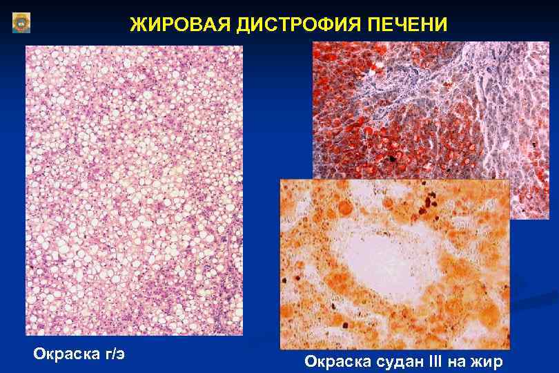 Жировая дистрофия печени. Жировая дистрофия печени Судан 3 гематоксилин. Жировая дистрофия печени окраска Суданом. Жировой гепатоз Судан 3. Микропрепарат жировая дистрофия печени окраска Суданом 3.