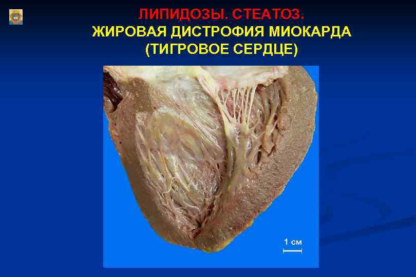 ЛИПИДОЗЫ. СТЕАТОЗ. ЖИРОВАЯ ДИСТРОФИЯ МИОКАРДА (ТИГРОВОЕ СЕРДЦЕ) 