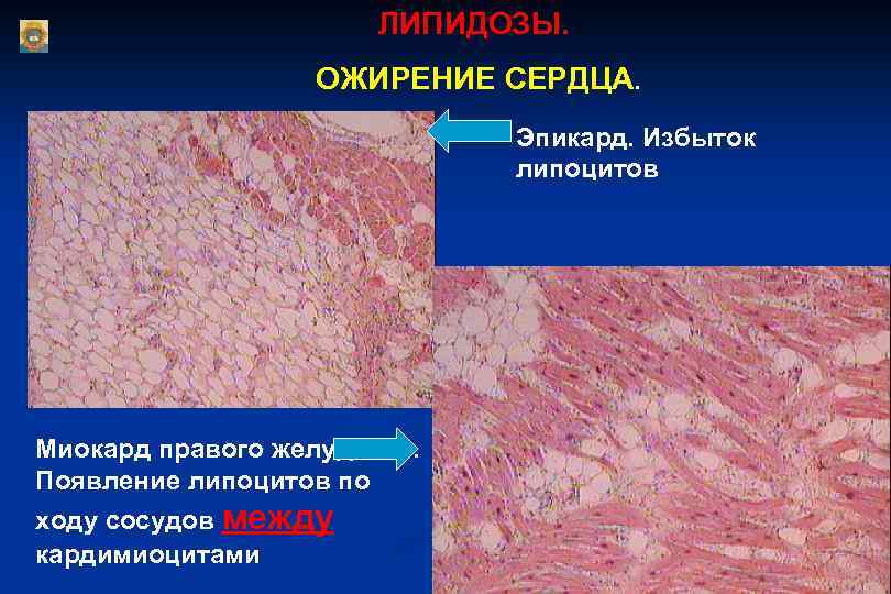 ЛИПИДОЗЫ. ОЖИРЕНИЕ СЕРДЦА. Эпикард. Избыток липоцитов Миокард правого желудочка. Появление липоцитов по ходу сосудов