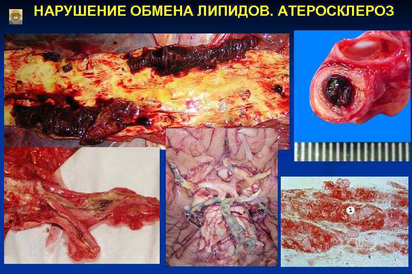 НАРУШЕНИЕ ОБМЕНА ЛИПИДОВ. АТЕРОСКЛЕРОЗ 