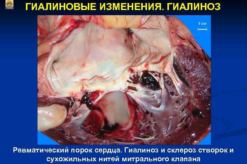 ГИАЛИНОВЫЕ ИЗМЕНЕНИЯ. ГИАЛИНОЗ Ревматический порок сердца. Гиалиноз и склероз створок и сухожильных нитей митрального