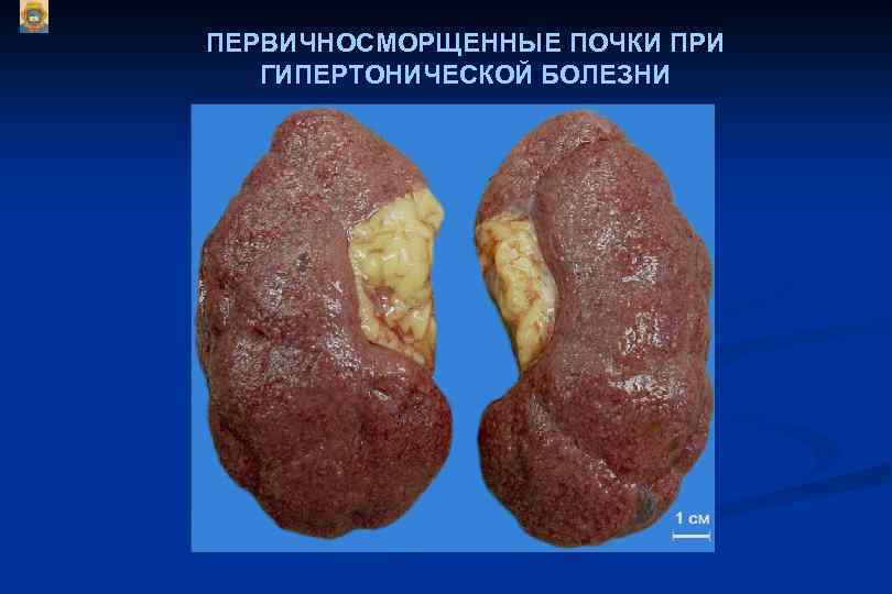 ПЕРВИЧНОСМОРЩЕННЫЕ ПОЧКИ ПРИ ГИПЕРТОНИЧЕСКОЙ БОЛЕЗНИ 