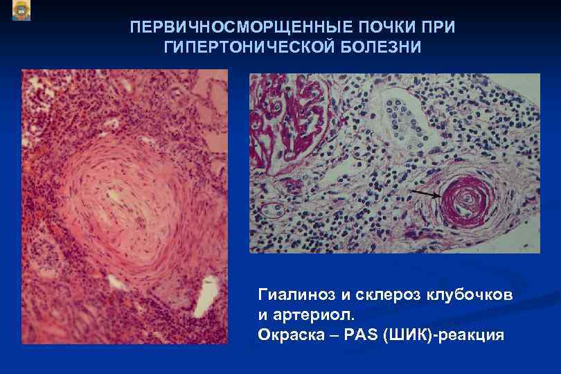 ПЕРВИЧНОСМОРЩЕННЫЕ ПОЧКИ ПРИ ГИПЕРТОНИЧЕСКОЙ БОЛЕЗНИ Гиалиноз и склероз клубочков и артериол. Окраска – РАS