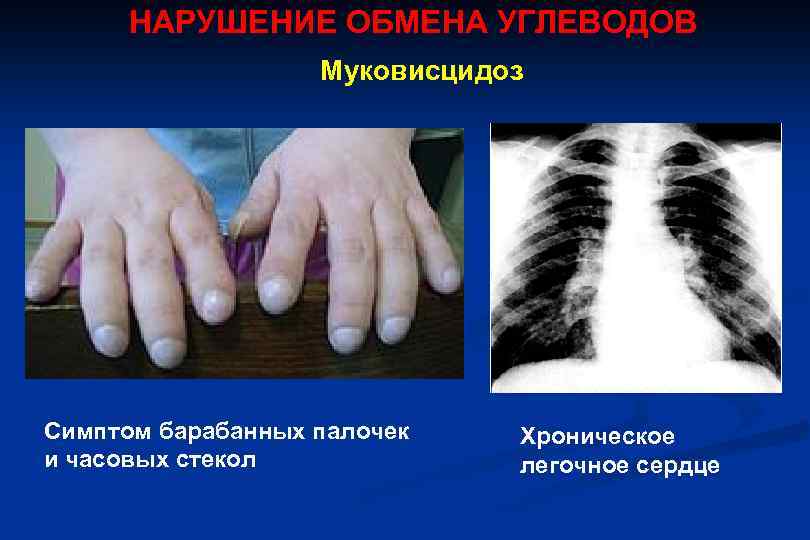 НАРУШЕНИЕ ОБМЕНА УГЛЕВОДОВ Муковисцидоз Симптом барабанных палочек и часовых стекол Хроническое легочное сердце 