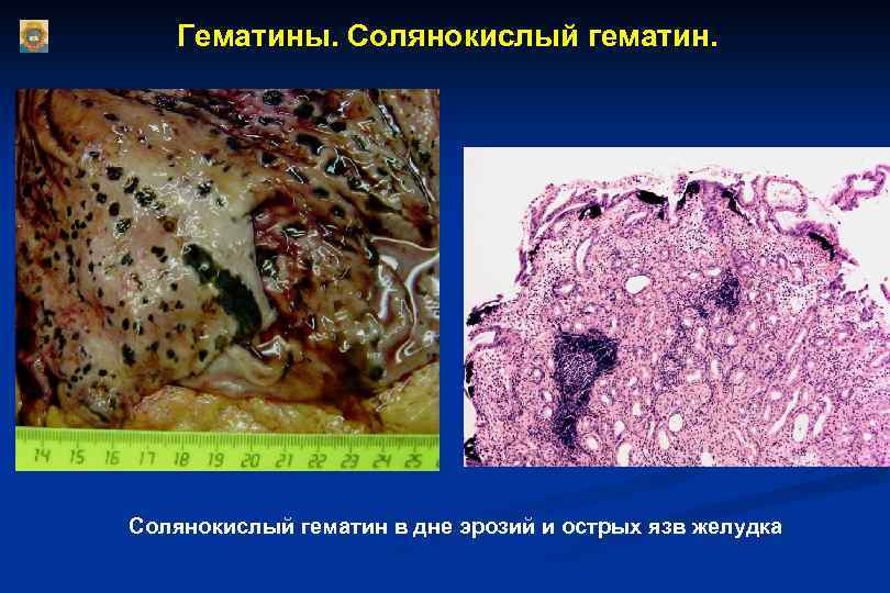 Гематины. Солянокислый гематин в дне эрозий и острых язв желудка 