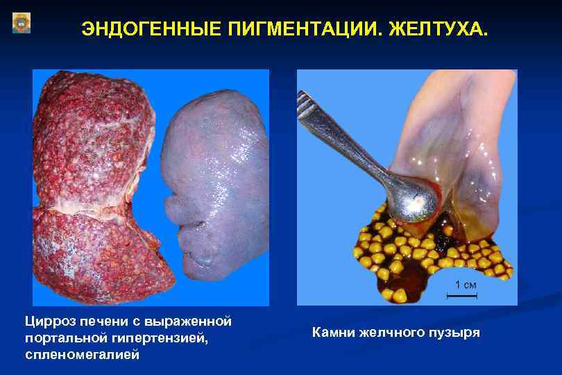 ЭНДОГЕННЫЕ ПИГМЕНТАЦИИ. ЖЕЛТУХА. Цирроз печени с выраженной портальной гипертензией, спленомегалией Камни желчного пузыря 