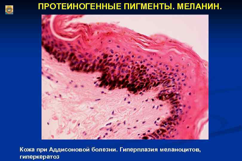 ПРОТЕИНОГЕННЫЕ ПИГМЕНТЫ. МЕЛАНИН. Кожа при Аддисоновой болезни. Гиперплазия меланоцитов, гиперкератоз 
