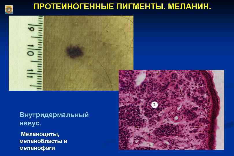 ПРОТЕИНОГЕННЫЕ ПИГМЕНТЫ. МЕЛАНИН. Внутридермальный невус. Меланоциты, меланобласты и меланофаги 