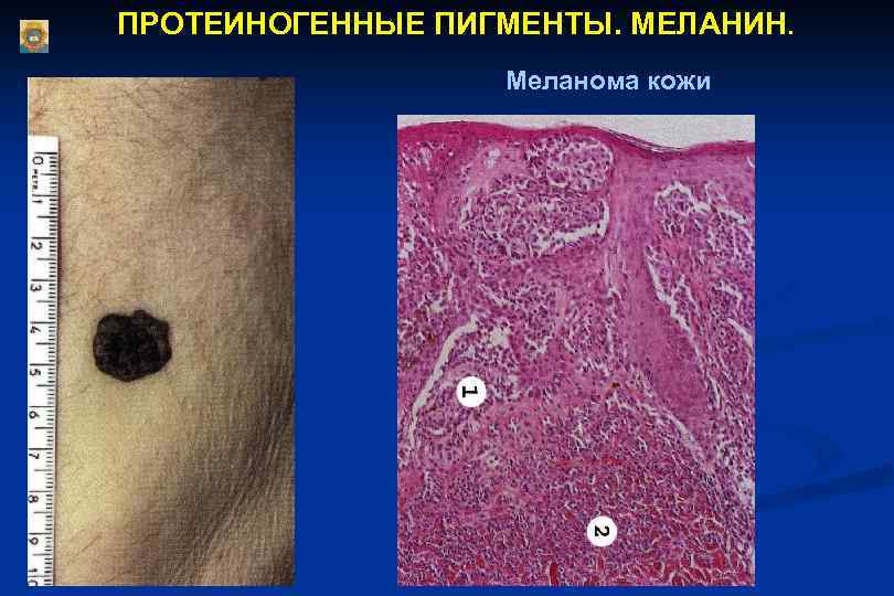 ПРОТЕИНОГЕННЫЕ ПИГМЕНТЫ. МЕЛАНИН. Меланома кожи 