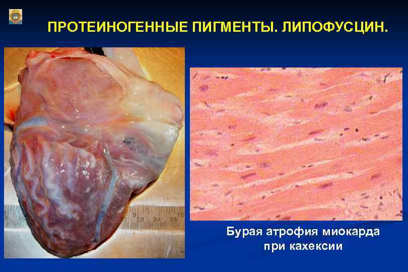 ПРОТЕИНОГЕННЫЕ ПИГМЕНТЫ. ЛИПОФУСЦИН. Бурая атрофия миокарда при кахексии 