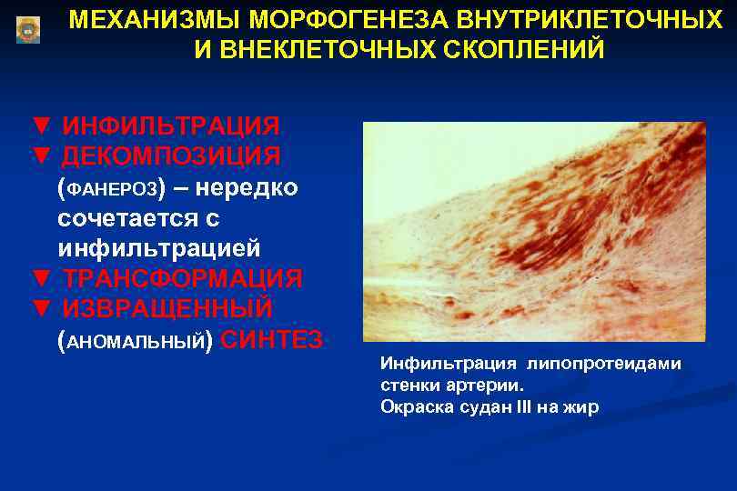 МЕХАНИЗМЫ МОРФОГЕНЕЗА ВНУТРИКЛЕТОЧНЫХ И ВНЕКЛЕТОЧНЫХ СКОПЛЕНИЙ ▼ ИНФИЛЬТРАЦИЯ ▼ ДЕКОМПОЗИЦИЯ (ФАНЕРОЗ) – нередко сочетается