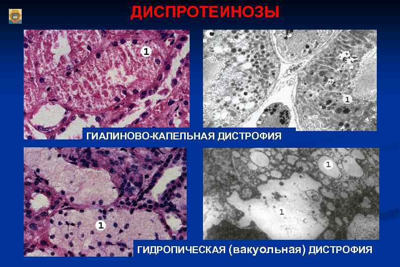 Роговая дистрофия. Гидропическая и гиалиново капельная дистрофия. Гиппиновокапельная дистрофия. Паренхиматозные белковые дистрофии гиалиново капельная. Гиалиноз капельная дистрофия.