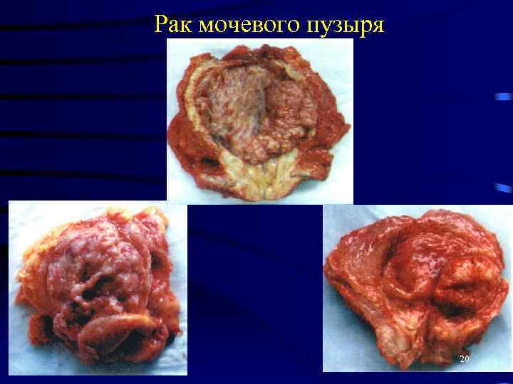 Рак мочевого пузыря 20 