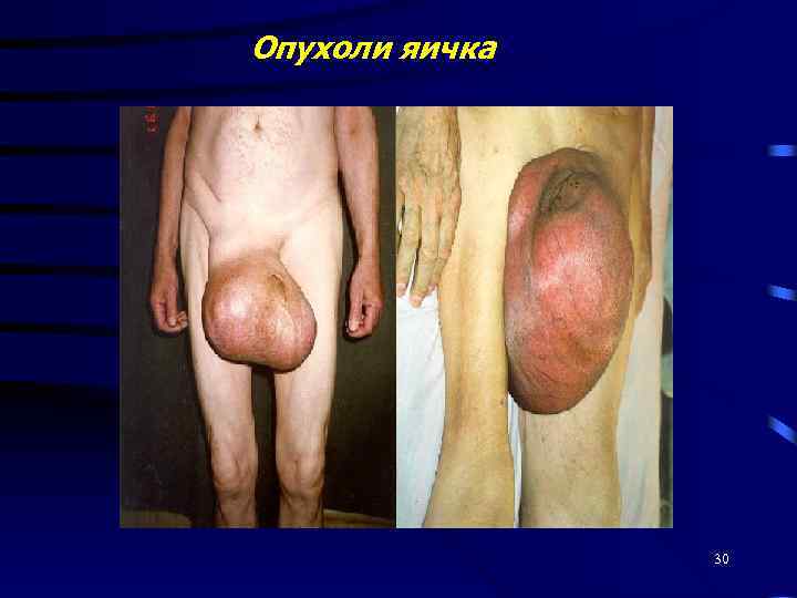 Опухоли яичка 30 