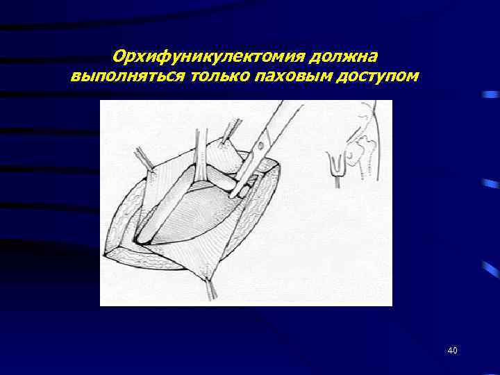 Орхифуникулектомия должна выполняться только паховым доступом 40 