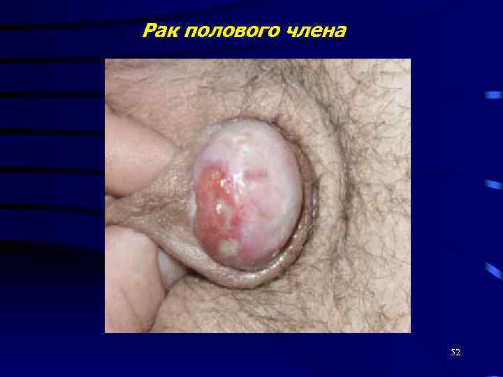Рак полового члена 52 