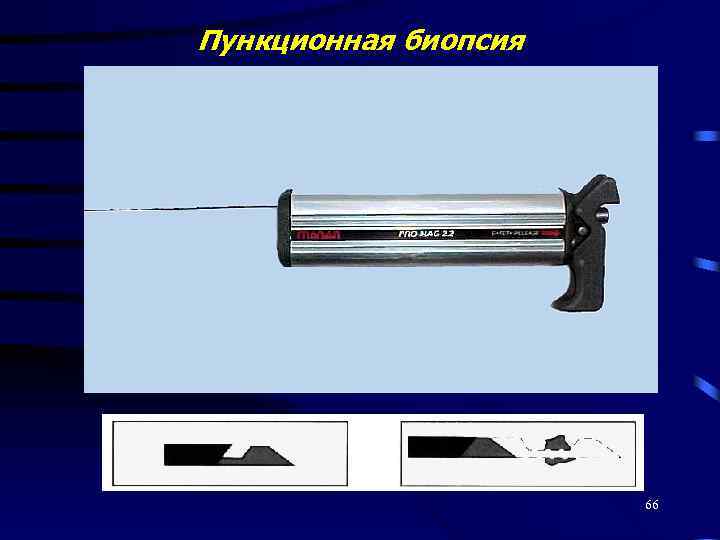 Пункционная биопсия 66 