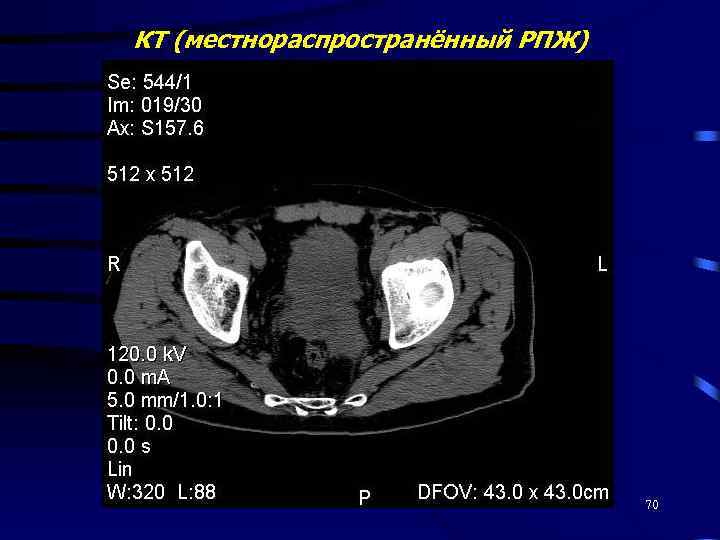 КТ (местнораспространённый РПЖ) 70 