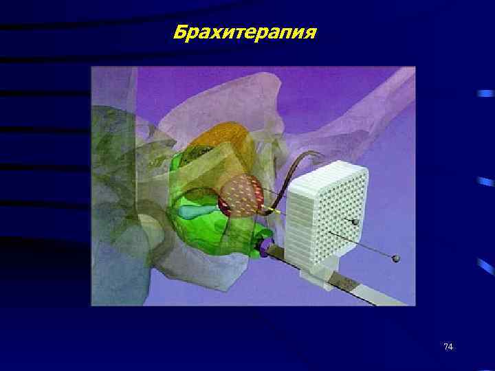 Брахитерапия 74 