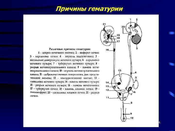 Причины гематурии 14 