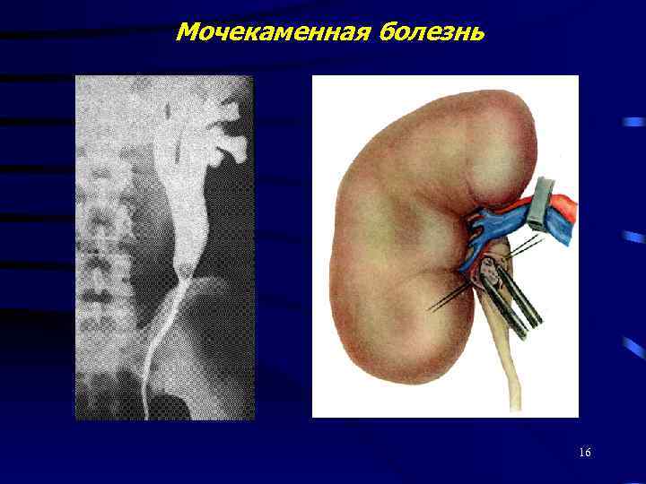 Мочекаменная болезнь 16 