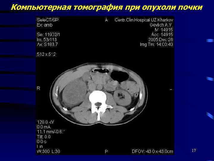 Компьютерная томография при опухоли почки 17 