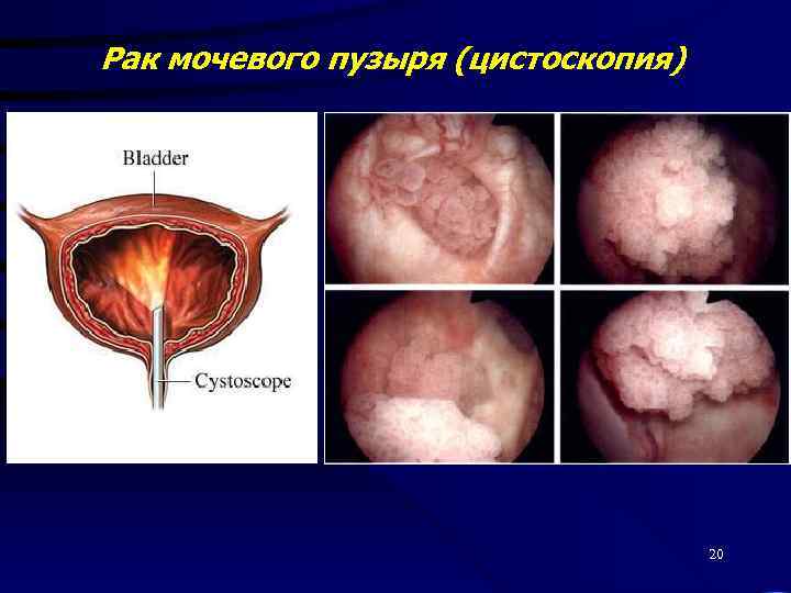 Рак мочевого пузыря (цистоскопия) 20 