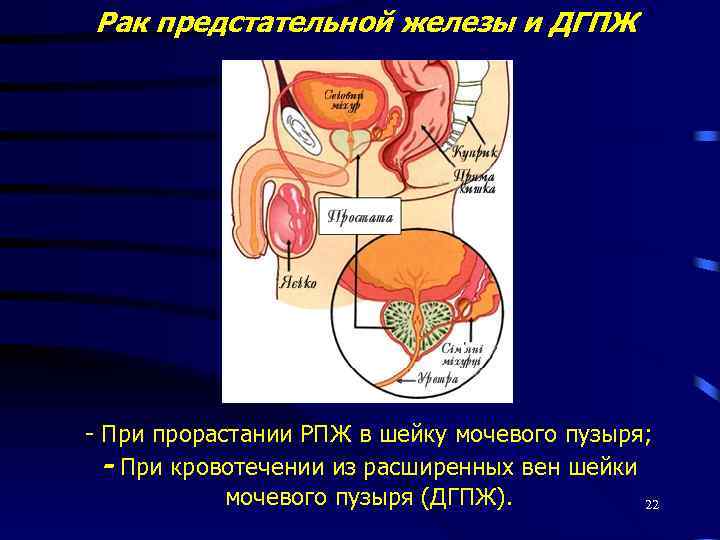 Рак предстательной железы и ДГПЖ - При прорастании РПЖ в шейку мочевого пузыря; -