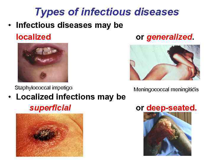 Types of infectious diseases • Infectious diseases may be localized Staphylococcal impetigo • Localized