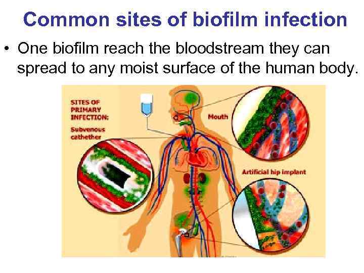 Common sites of biofilm infection • One biofilm reach the bloodstream they can spread