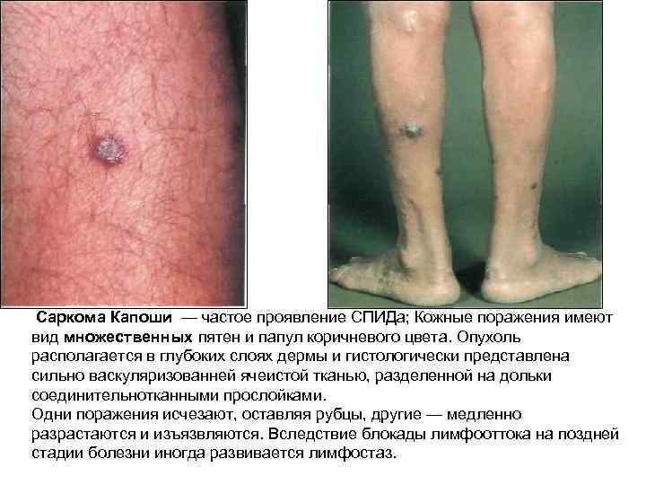  Саркома Капоши — частое проявление СПИДа; Кожные поражения имеют вид множественных пятен и