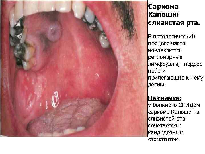 Саркома Капоши: слизистая рта. В патологический процесс часто вовлекаются регионарные лимфоузлы, твердое небо и