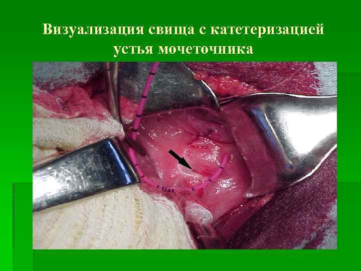 Визуализация свища с катетеризацией устья мочеточника 