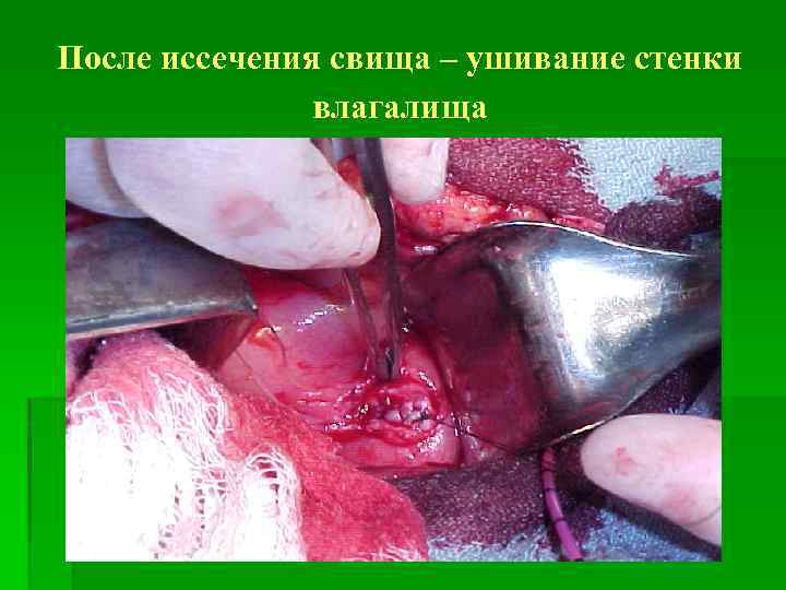 После иссечения свища – ушивание стенки влагалища 