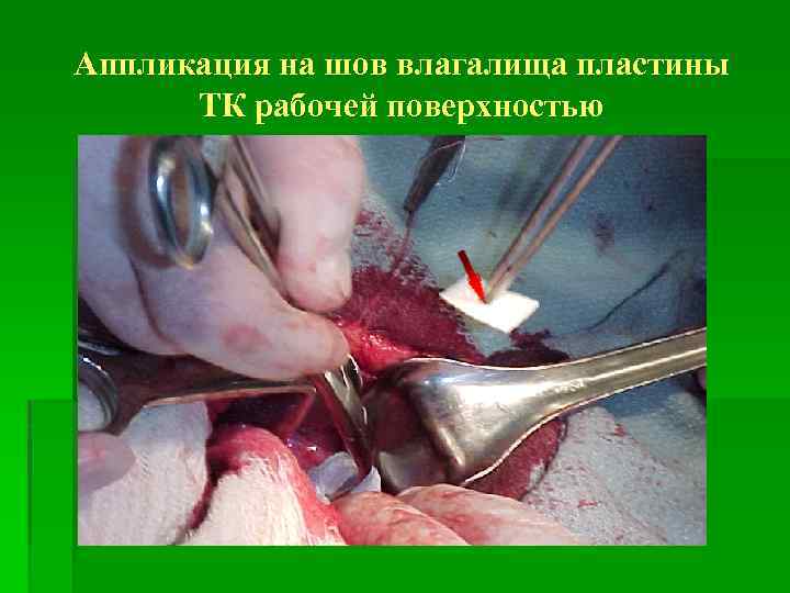 Аппликация на шов влагалища пластины ТК рабочей поверхностью 