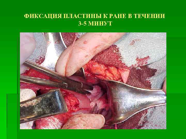 ФИКСАЦИЯ ПЛАСТИНЫ К РАНЕ В ТЕЧЕНИИ 3 -5 МИНУТ 