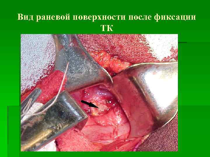 Вид раневой поверхности после фиксации ТК 