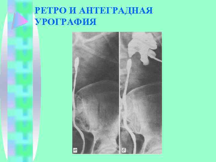 РЕТРО И АНТЕГРАДНАЯ УРОГРАФИЯ 