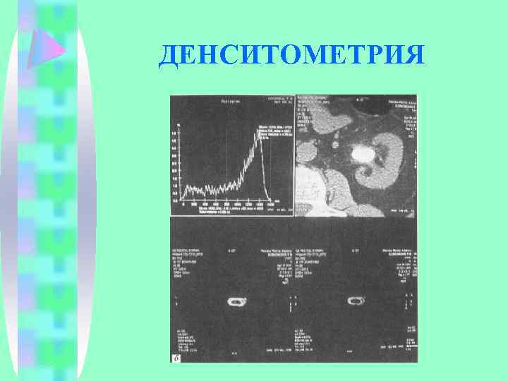 ДЕНСИТОМЕТРИЯ 