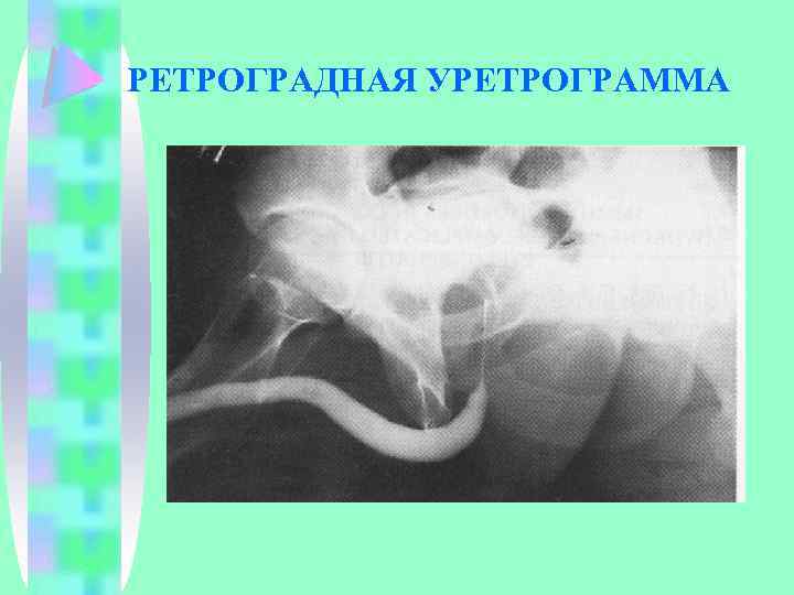 РЕТРОГРАДНАЯ УРЕТРОГРАММА 