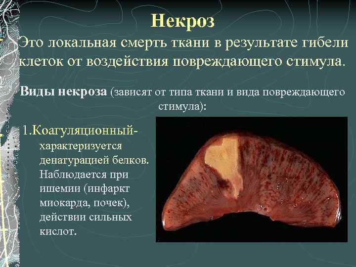 Некроз Это локальная смерть ткани в результате гибели клеток от воздействия повреждающего стимула. Виды