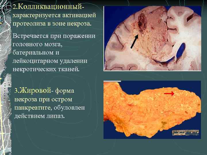 2. Колликвационныйхарактеризуется активацией протеолиза в зоне некроза. Встречается при поражении головного мозга, батериальном и